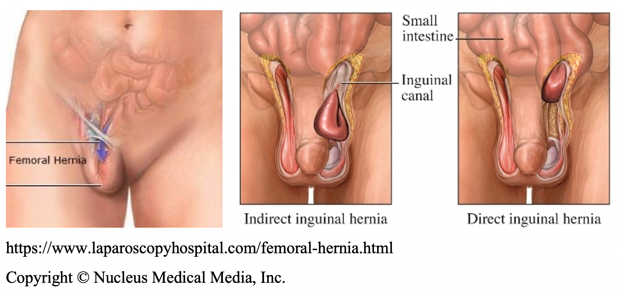 Inguinal and femoral hernia, Faculty of Medicine