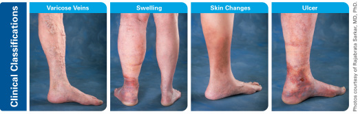 A deeper look into chronic venous insufficiency