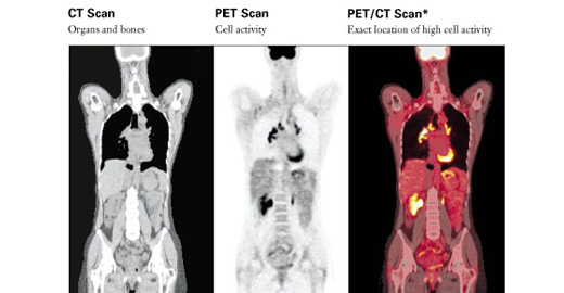 Pet Ct Scan University Radiology Associates Llp Suny Upstate Medical University