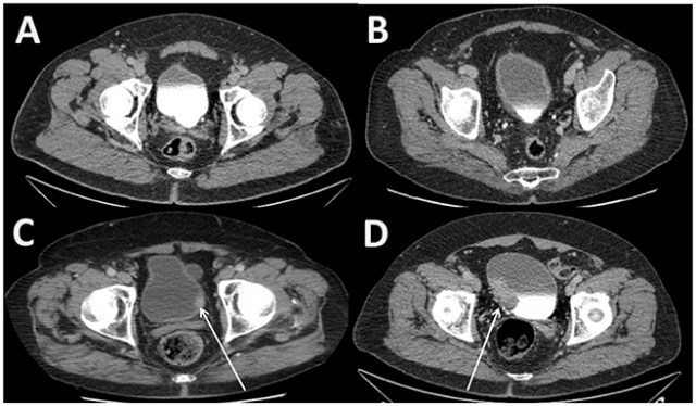 thickening of bladder wall in males