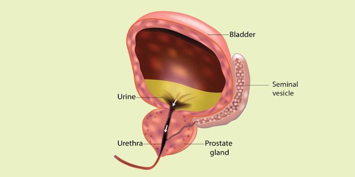 male-prostate-cancer-diagram-432062-vector-art-at-vecteezy