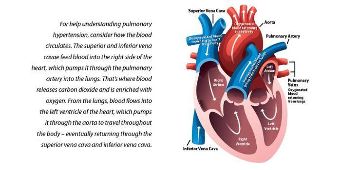 pulmonary-hypertension-what-s-up-at-upstate-suny-upstate